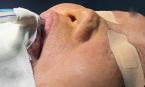 Bệnh nhân U70 biến dạng mũi sau 7 lần phẫu thuật